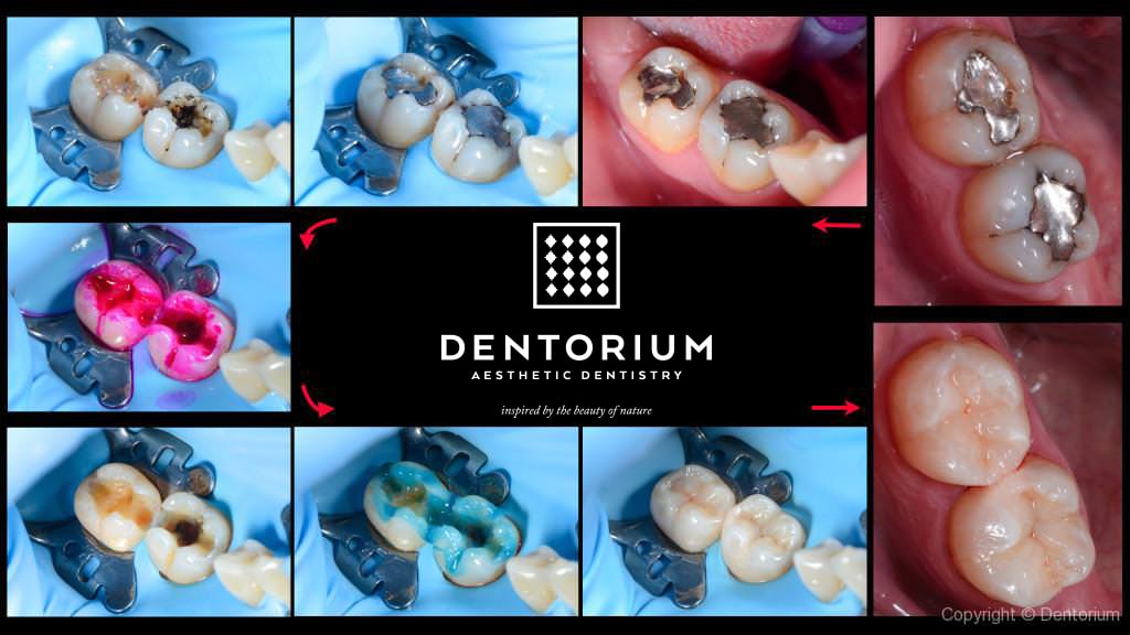 lo scambio delle amalgame d'argento