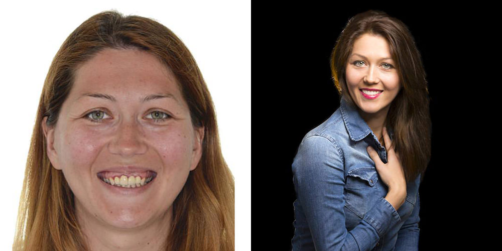 La foto extra-orale Prima & Dopo