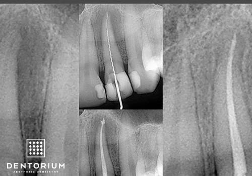 Endodonzia - Cura canalare