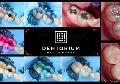 Ricostruzioni estetiche o otturazioni