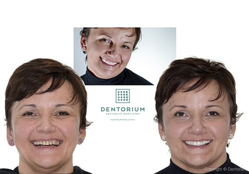 La Dimesione Verticale - sorridere nel tempo