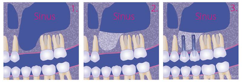 sinus lift
