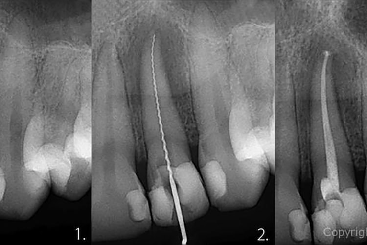 Trattamento Canalare