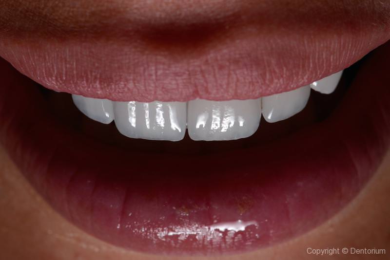 la nostra paziente Marina - tipi di corone in ceramica