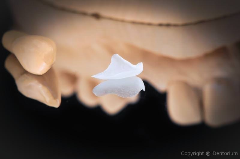 faccette ceramica - prepless faccett