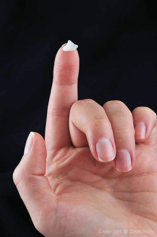 faccette ceramica - prepless faccett