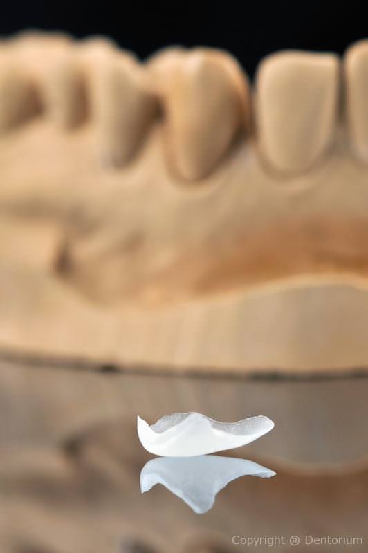 faccette ceramica - prepless faccett