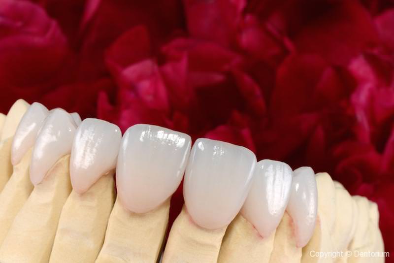 tipi di faccette in ceramica - la nostra paziente Suzana