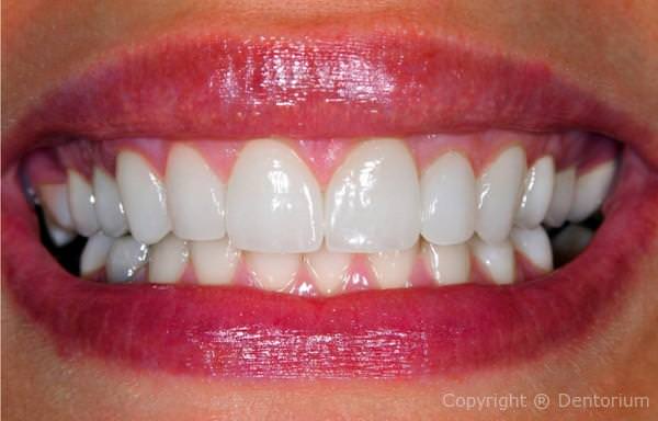 trattamento parodontale