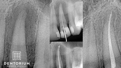 Dentorium Angolo info: e chiesto di endodonzia