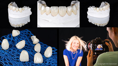 I tipi di corone in ceramica